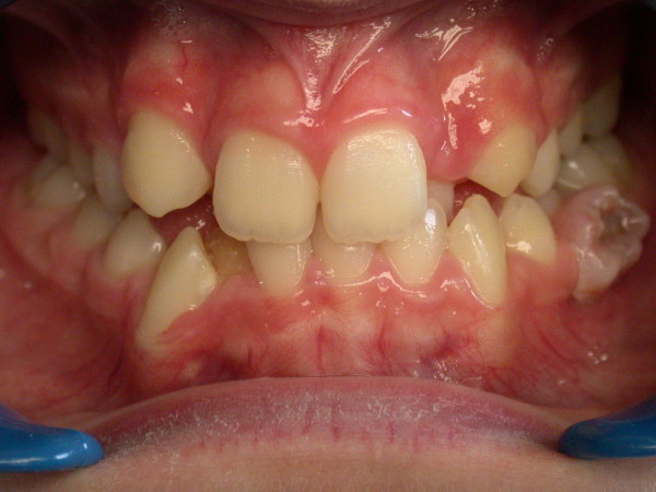 Exemple 4 : position palatine des incisives - Orthodontie à SECLIN