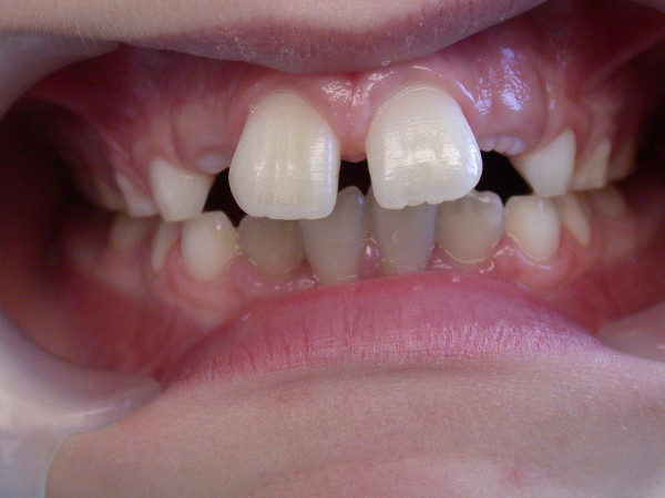 Exemple 5 : malocclusion classe II - Orthodontie à SECLIN