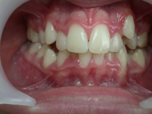 Exemple 1 : malocclusion - Orthodontie à SECLIN