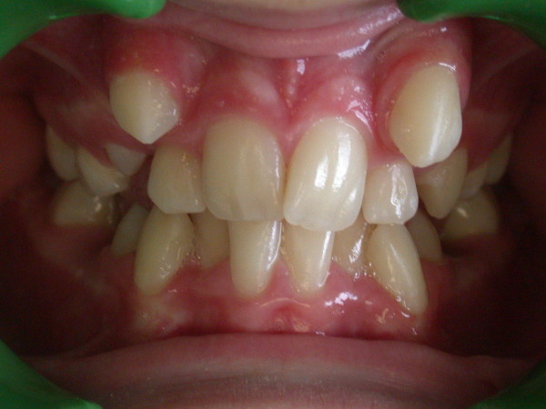 Exemple 2 : malocclusion classe I - Orthodontie à SECLIN