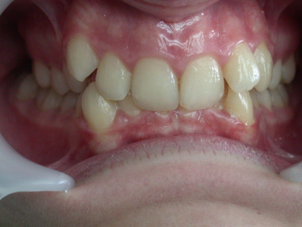 Exemple 14 : extraction prémolaires - Orthodontie à SECLIN
