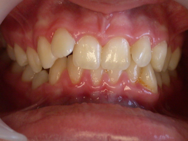 Exemple 3 : chevauchement dentaire - Orthodontie à SECLIN