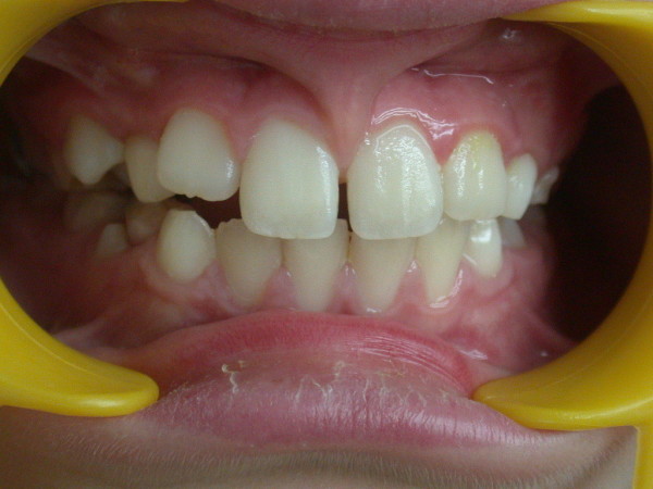 Exemple 8 : Freinectomie labiale - Orthodontie à SECLIN