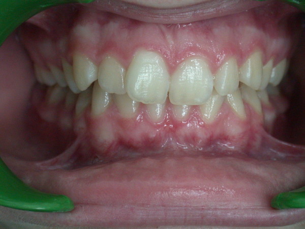 Exemple 11 : malocclusion dentaire - Orthodontie à SECLIN