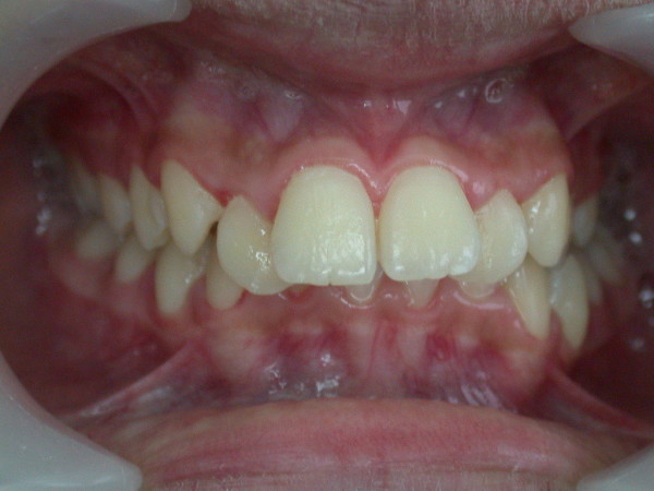 Exemple 6 - Orthodontie à SECLIN