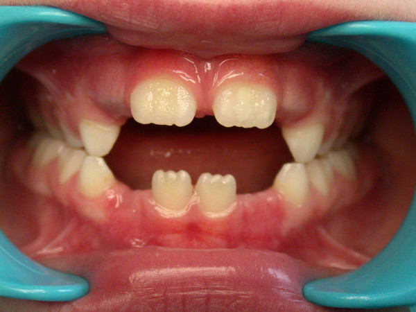 Exemple 9 : Béance - Orthodontie à SECLIN
