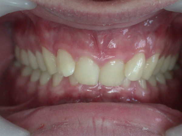 Exemple 10 : malocclusion classe II- Orthodontie à SECLIN
