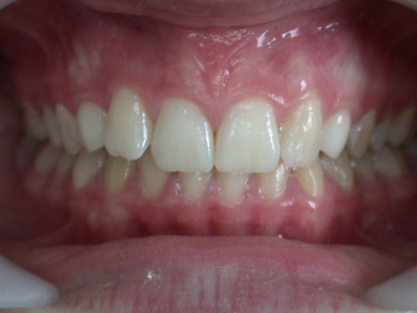 Exemple 13 - Orthodontie à SECLIN