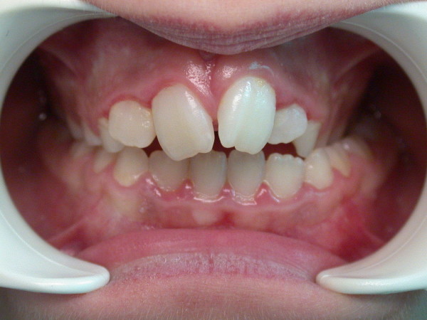 Exemple 12 : traitement précoce - Orthodontie à SECLIN